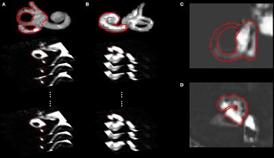 Three-Dimensional Volumetric Measurement of Endolymphatic Hydrops in Meniere's Disease